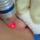Диодные лазеры для лечения сосудов
