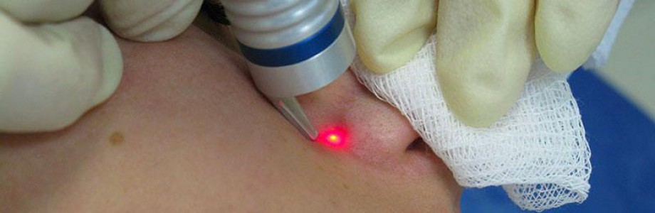 Диодные лазеры для лечения сосудов
